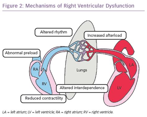 Right Ventricular Dysfunction and the “D”